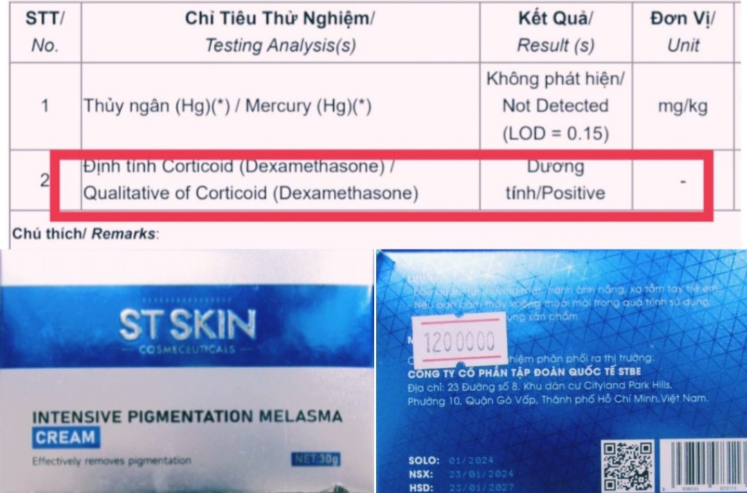 ​Nghi vấn kem trị nám ST SKIN Intensive Pigmentation Melasma do STBE Group phân phối có chứa độc dược nhóm B- Corticoid