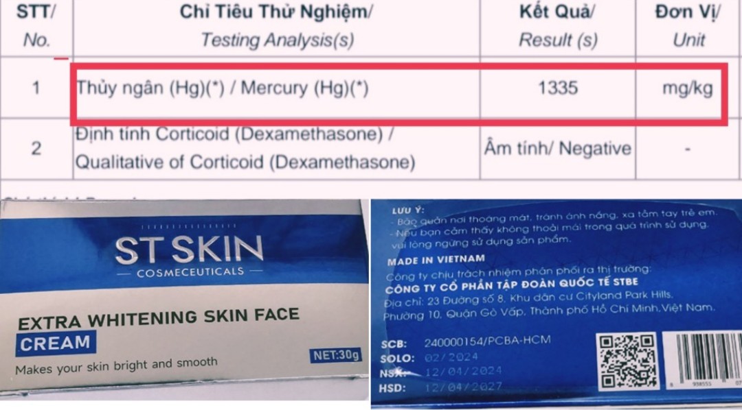 Sản phẩm ST SKIN Extra Whitening Skin Face do STBE Group chịu trách nhiệm phân phối ra thị trường có chứa thủy ngân